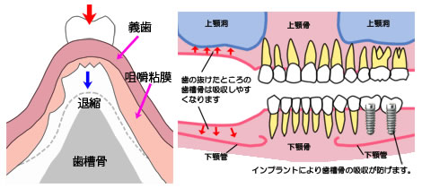 歯を失ってしまうと歯を支えている骨（歯槽骨）はどんどん吸収され、インプラントを入れることも難しくなってしまう