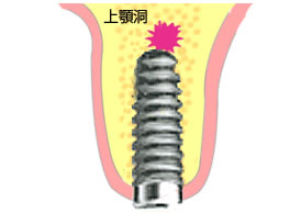 上顎の骨へインプラントを埋める時、ドリルによる鼻腔および上顎洞への穿孔