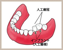 ブリッジで両端の健康な歯を削りたくない