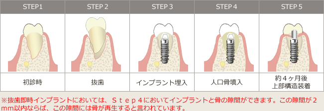 抜歯即時埋入法のデメリット